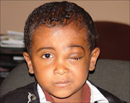 طفل يمني أفقده السرطان عينا (الجزيرة نت) 