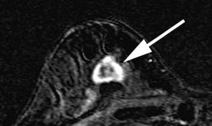 FILE - This undated file image provided in 2007 by the Duke University Department of Medicine shows a right breast MRI from a 55-year-old woman with extreme breast density. The superimposed arrow points to a 2 cm rapidly enhancing lesion which was later confirmed by biopsy to be invasive breast cancer. Doctors have successfully dropped the first "smart bomb" on breast cancer, using a drug to deliver a toxic payload to tumor cells while leaving healthy ones alone, doctors plan to report Sunday, June 3, 2012.