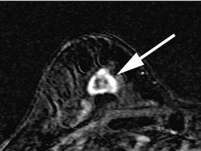 FILE - This undated file image provided in 2007 by the Duke University Department of Medicine shows a right breast MRI from a 55-year-old woman with extreme breast density. The superimposed arrow points to a 2 cm rapidly enhancing lesion which was later confirmed by biopsy to be invasive breast cancer. Doctors have successfully dropped the first "smart bomb" on breast cancer, using a drug to deliver a toxic payload to tumor cells while leaving healthy ones alone, doctors plan to report Sunday, June 3, 2012.