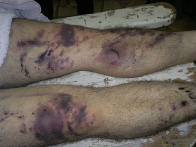 صورة تظهر آثار التعذيب على جسم أحد المعتقلين في أحد أفرع الأمن السورية (الجزيرة)