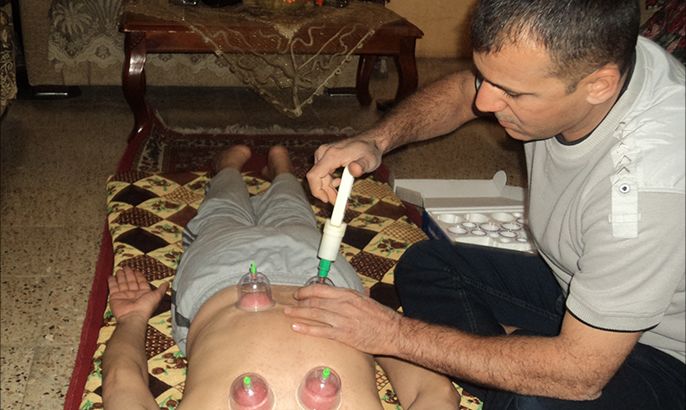 الحجامة قبلة المحبطين من الأطباء بجنوب العراق