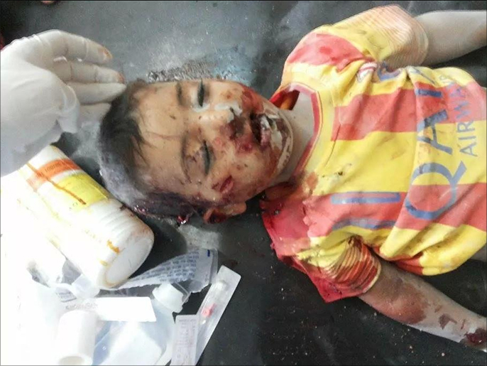 صورة وزعها ناشطون لطفل قتل في قصف الطيران الحكومي لمستشفى بالحويجة