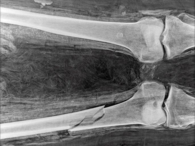 epa01336373 Commercial handout image released by the Field Museum on 07 May 2008 showing the right femur of an ancient Egyptian mummy that reveals the absence of new bone growth near the fracture, indicating that the leg was broken after the person died and the body mummified.