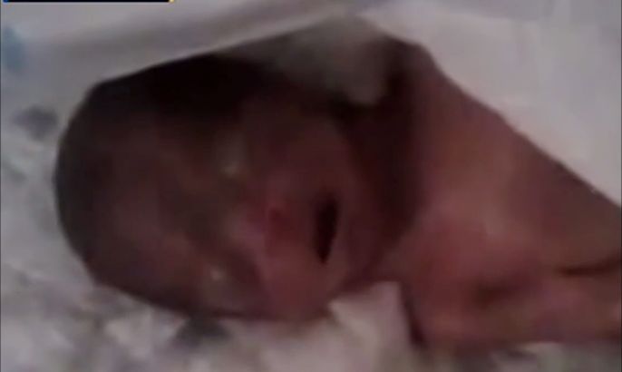 خمس ولادات مشوهة في الغوطة بسبب الكيميائي