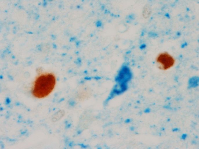 This undated image provided by the Mayo Clinic shows an abnormal TDP-43, the two circular brown blobs, in the brain of a patient with tau neurofibrillary tangle, blue flame shape blob in the middle, and Alzheimer’s disease during the pathological analyses in Rochester, Minn. Scientists have linked a new protein to Alzheimer's disease, different from the amyloid and tau that make up the sticky brain plaques and tangles long known to be its hallmarks and was discussed Wednesday, July 16, 2014, at the Alzheimer's Association International Conference in Copenhagen. (AP Photo/Mayo Clinic)