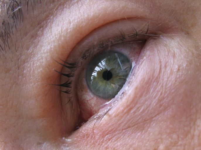 إلى جانب احمرار العين تتمثل أعراض التهاب الملتحمة في زيادة إفرازات الدموع والتصاق الجفون والشعور بالألم عند تحريك مقلة العين. (النشر مجاني لعملاء وكالة الأنباء الألمانية "dpa". لا يجوز استخدام الصورة إلا مع النص المذكور وبشرط الإشارة إلى مصدرها.) عدسة: dpa
