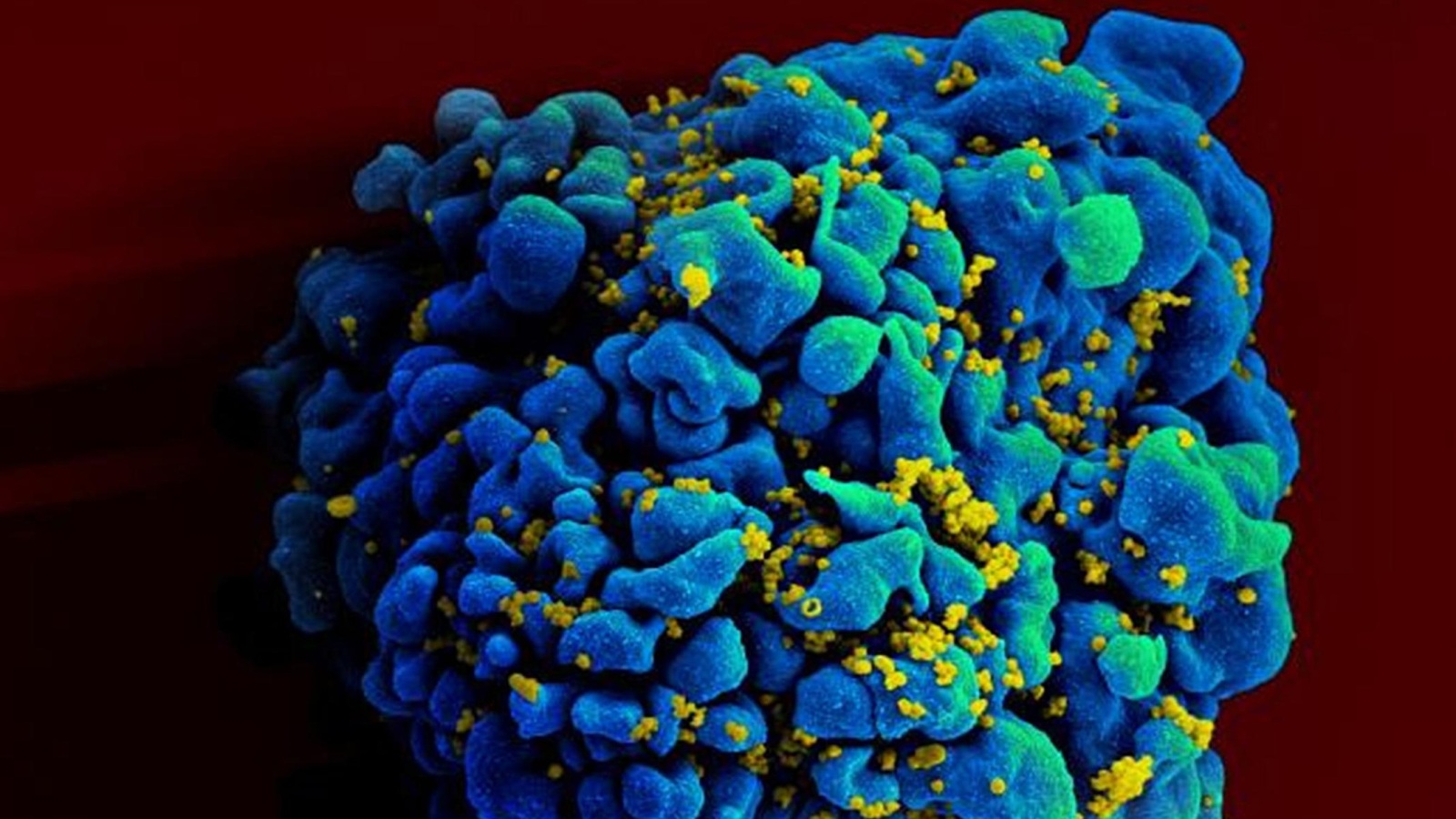 ‪فيروس الإيدز‬ (باللون الأصفر)(بالأزرق)(أسوشيتد برس)