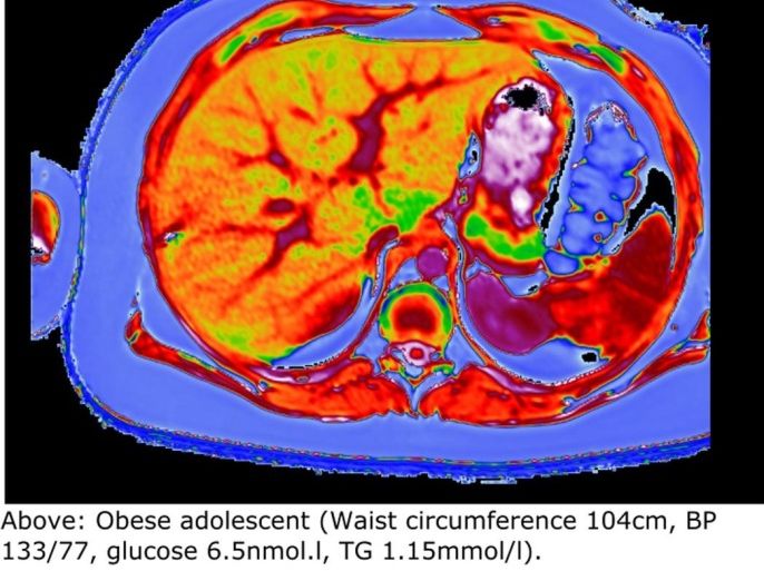 A handout combination image of MRI scans shows a healthy liver (bottom) compared with that of an obese 12-year-old suffering from NASH (nonalcoholic steatohepatitis), captured using Perspectum Diagnostics' Liver MultiScan technology in Oxford, England released on March 13, 2015. A healthy liver shows primarily in dark green. The mostly red liver indicates the presence of fat deposits. As drugmakers develop new medicines to battle a liver disease epidemic, they have created an urgent need for better diagnostics to select patients for treatment and assess their drugs' effectiveness. About 30 percent of people in the U.S. now suffer from fatty liver diseases, such as NASH, fueled by obesity, diabetes and over-indulgent lifestyles, according to the American Liver Foundation. Without treatment, sufferers can develop advanced damage, including the scarring known as fibrosis; cirrhosis, which destroys liver function; and even cancer. To match Insight LIVER-DIAGNOSTICS/ REUTERS/Perspectum Diagnostics Ltd/Handout via Reuters (UNITED KINGDOM - Tags: HEALTH SCIENCE TECHNOLOGY DRUGS SOCIETY) ATTENTION EDITORS - THIS PICTURE WAS PROVIDED BY A THIRD PARTY. REUTERS IS UNABLE TO INDEPENDENTLY VERIFY THE AUTHENTICITY, CONTENT, LOCATION OR DATE OF THIS IMAGE. FOR EDITORIAL USE ONLY. NOT FOR SALE FOR MARKETING OR ADVERTISING CAMPAIGNS. NO SALES. NO ARCHIVES. THIS PICTURE IS DISTRIBUTED EXACTLY AS RECEIVED BY REUTERS, AS A SERVICE TO CLIENTS