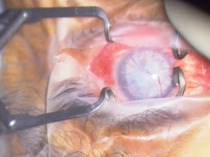 عين المريض فياض أثناء إجراء الجراحة 2 (الجزيرة نت
