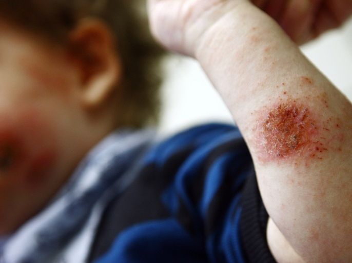 حيل لتسهيل استعمال كريمات التهاب الجلد العصبي مع الأطفال