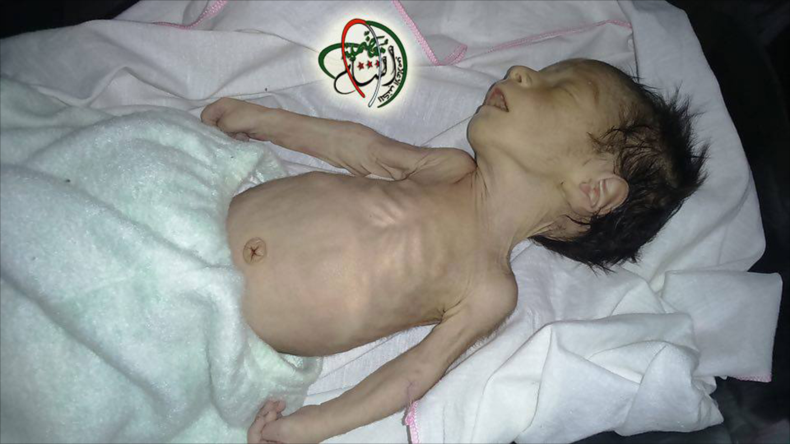 ‪طفل لقي حتفه بمعضمية الشام جراء سوء التغذية‬ (ناشطون)