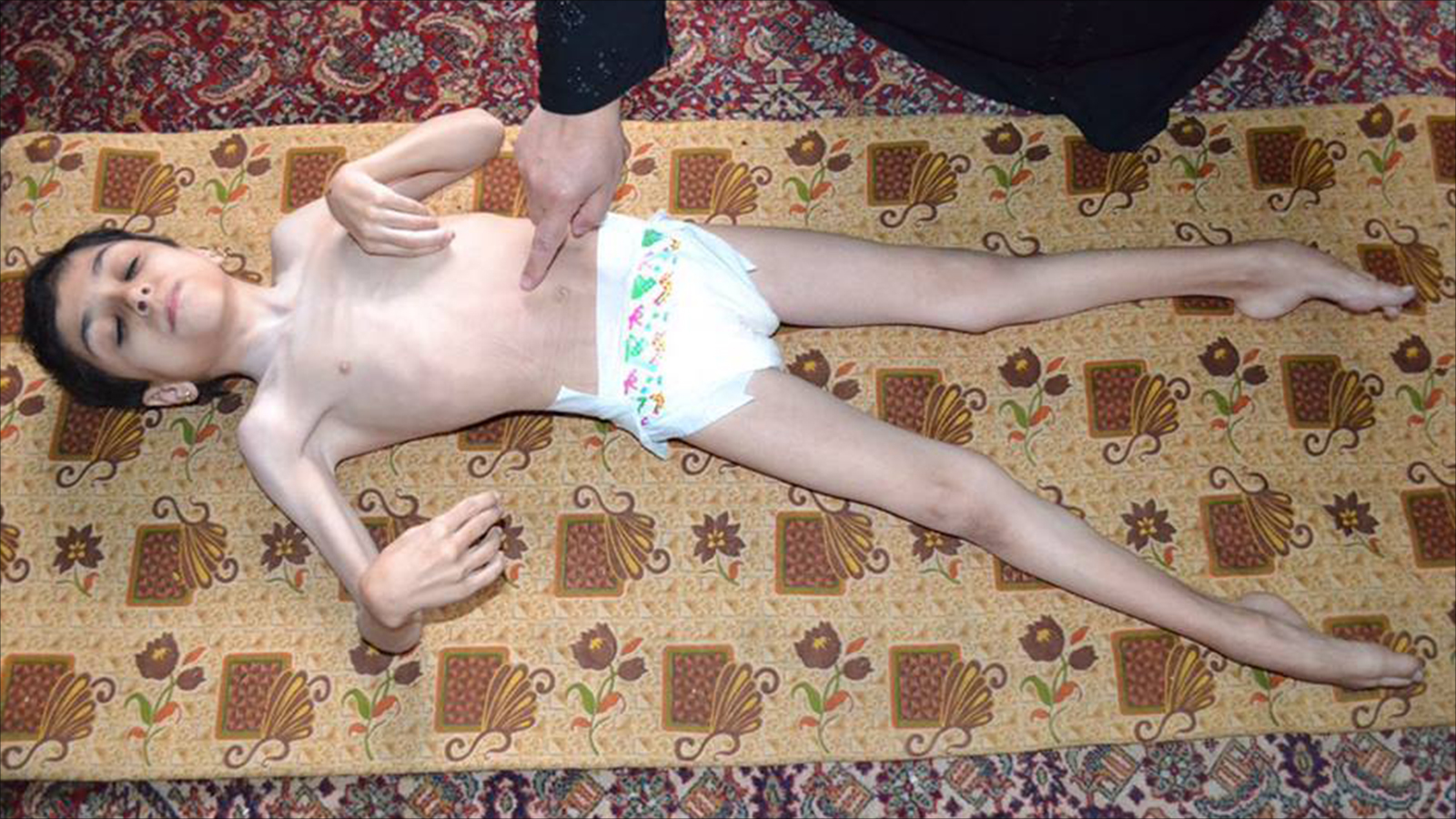 طفل معاق تردت حالته الصحية جراء الحصار المفروض على ريف حمص الشمالي (الجزيرة نت)