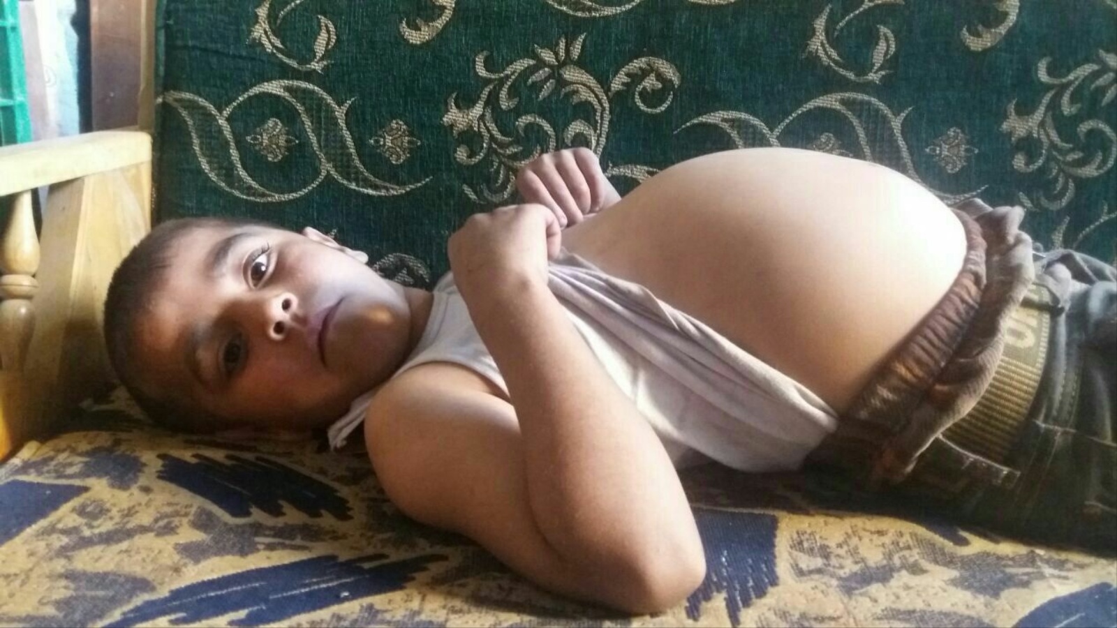 ‪أحد الأطفال المصابين بحالات انتفاخ البطن في بلدة مضايا‬ (الجزيرة)