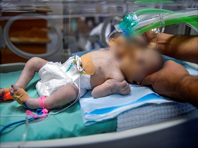 ولادة توأمين برأسين وجسد واحد في غزة