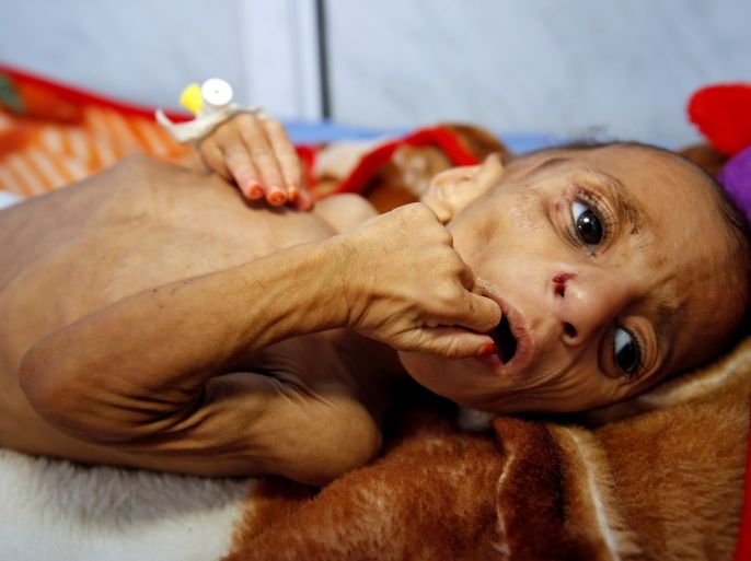 One-year-old Fatima Abdullah Hassan, who suffers from severe malnutrition, lies in bed at a malnutrition treatment center in the Red Sea port city of Hodeida, Yemen December 20, 2017. REUTERS/Abduljabbar Zeyad