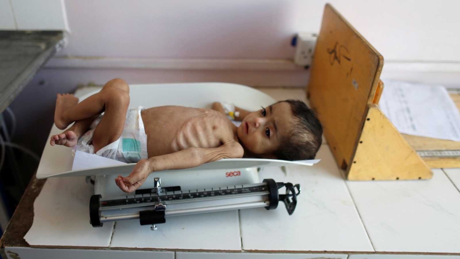 عشرات آلاف الأطفال في اليمن يعانون من سوء التغذية الحاد (رويترز)