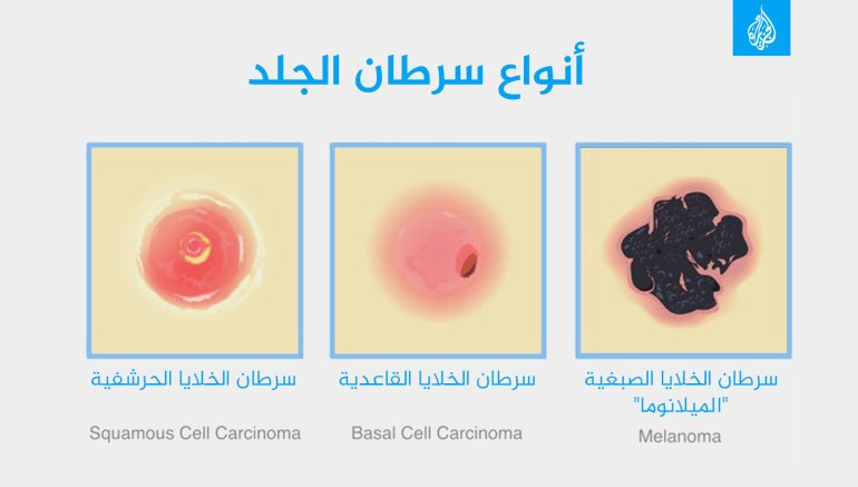 أنواع سرطان الجلد