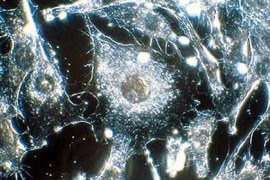 صورة مجهرية للخلايا السرطانية في الإنسان