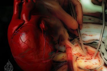 تكرار القسطرة قد يؤدي الى مشاكل في القلب