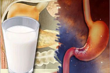 تناول منتجات الكالسيوم والحليب يقلل من الإصابة بسرطان القولون