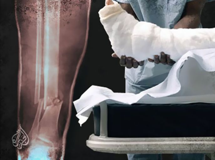 علاج للعظام يقلل من مخاطر الوفاة بعد الاصابة بكسور بالورك