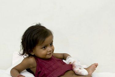 epa01166022 This hospital handout picture made available on 06 November 2007 shows an unidentified doctor (R) talk to two-year-old Lakshmi, an eight-limbed girl named after a Hindu goddess,