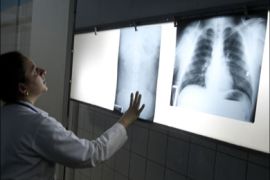 r : A doctor looks at the x-rays of a victim of a bus attack in Guatemala City March 25, 2009. In two early morning attacks, at least two drivers were killed and four people