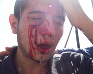 أحد المصابين في المواجهات مع قوات الاحتلال قرب الأقصى (الجزيرة نت)