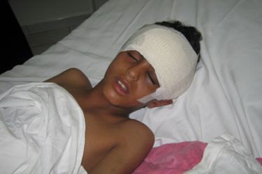 طفل يمني فقد النطق بسبب طلقة في رأسه برصاص قناصة في جمعة الكرامة (الجزيرة نت )