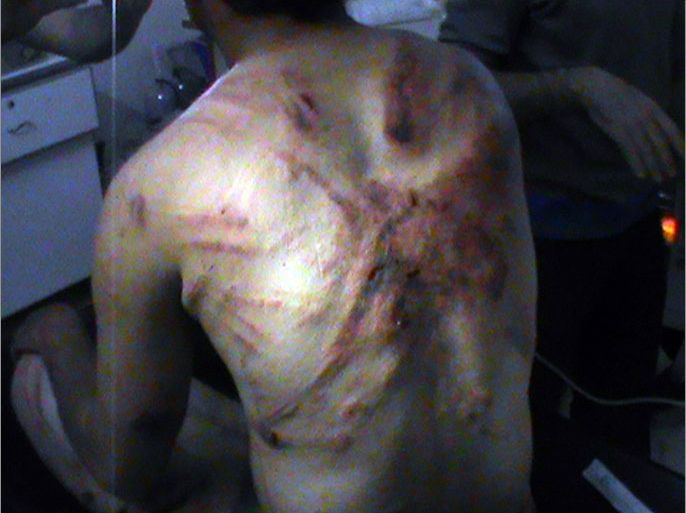 A Syrian man shows his injured back in the city of Rastan, north of the central resitive city of Homs on April 27, 2012 claiming that he was tortured by regime forces. Amnesty International said that it has received the names of more than 360 people reportedly killed in Syria since UN ceasefire observers deployed last week, and called for a more robust mission. AFP PHOTO/STR