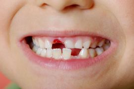 اعوجاج الأسنان قد يعيق التطور اللغوي لدى الطفل