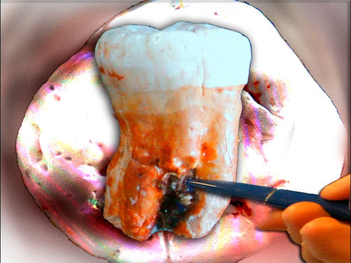 تصميم - يطلق مصطلح "تسوس الأسنان" على عملية فقدان بنيان السن الناجم عن الأحماض التي تفرزها البكتيريا في الفم، إذ تقوم أنواع معينة منها بهضم الكربوهيدرات من الطعام، وتنتج الأحماض التي تهاجم سطح المينا وتؤدي إلى خروج الكالسيوم وأيونات الفوسفات من سطح السن، وتقود عملية فقدان المعادن هذه إلى إضعاف المينا وحدوث فجوات فيها.