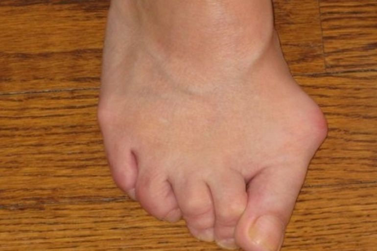 Typical Bunion Bone Deformity - Pre-Foot Surgery - Patient Suffered 20 Years Prior to Bunion Correction By Dr. Neufeld, Ludloff Plate Technique.
