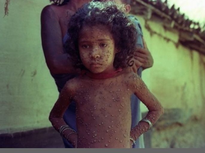 FILE - In this June 23, 1974 file photo a small Indian child displays the result of smallpox at Hakegora village in India. Smallpox, one of the world's deadliest diseases, eradicated three decades ago, is kept alive under tight security today in the United States and Russia. Many other countries say the world would be safer if those stockpiles of the virus were destroyed and now for the fifth time, at a World Health Organization meeting on May 16, 2011, they will push again for the virus' destruction but it seems their efforts will be futile as U.S. and Russian government officials say it is essential they keep some smallpox alive in case a future biological threat demands more tests with the virus.