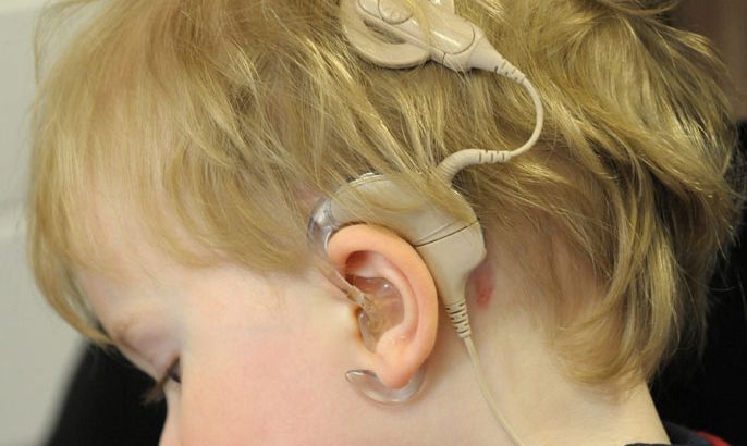 زراعة القوقعة تتيح للأطفال ضعاف السمع إدراك الأصوات والكلام
