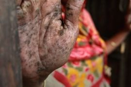 In this photo taken Feb. 22, 2010, Hanufa Bibi, 45, displays her palm, filled with small black warts caused by years of drinking arsenic-laced water, at her village in Chandipur, about 120 kilometers, 75 miles, east of Dhaka, Bangladesh. A new research funded by the U.S. National Institutes of Health has found that up to half of the 150 million people in this poor country have guzzled tainted groundwater and has linked it to 1 in 5 deaths in Bangladesh.