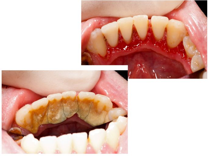 تكلسلات وجير على الأسنان الأمامية السفلية، قبل التنظيف وبعد التنظيف، الوكالة الفرعية زولت بوتا tartar calculus gingivitis