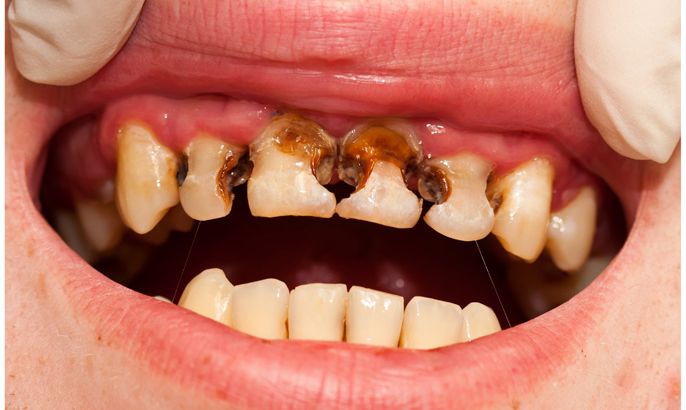 dental caries تسوس الأسنان، الوكالة الفرعية ساندور كاكسو