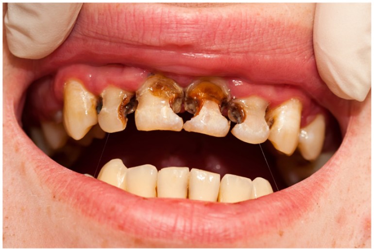 dental caries تسوس الأسنان، الوكالة الفرعية ساندور كاكسو