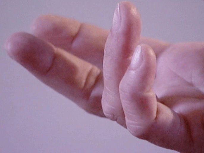 مرض تقوس الأصابع… الأسباب وطرق العلاج