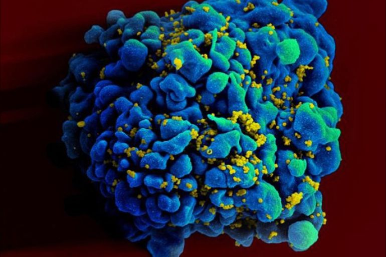 This April 12, 2011 electron microscope image made available by the National Institute of Allergy and Infectious Diseases shows an H9 T cell, colored in blue, infected with the human immunodeficiency virus (HIV), yellow. Doctors may one day be able to control a patient’s HIV infection in a new way: injecting swarms of germ-fighting antibodies, two new studies suggest. Reports by Dr. Dan Barouch of Harvard and the Beth Israel Deaconess Medical Center in Boston and the National Institutes of Health were published Wednesday, Oct. 30, 2013 in the journal Nature. (AP Photo/NIAID)