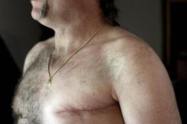 In this May 3, 2012 photo, a surgery scar is seen on breast cancer survivor Robert Kaitz's left breast in his home in Severna Park, Md. Kaitz thought a small growth under his left nipple was just a harmless cyst. By the time he had it checked out in 2006, almost two years later, the lump had started to hurt. The diagnosis was a shock. "I had no idea in the world that men could even get breast cancer," Kaitz said. Now Kaitz does frequent self-exams and has mammograms every year. The American Cancer Society estimates 1 in 1,000 men will get breast cancer, versus 1 in 8 women.