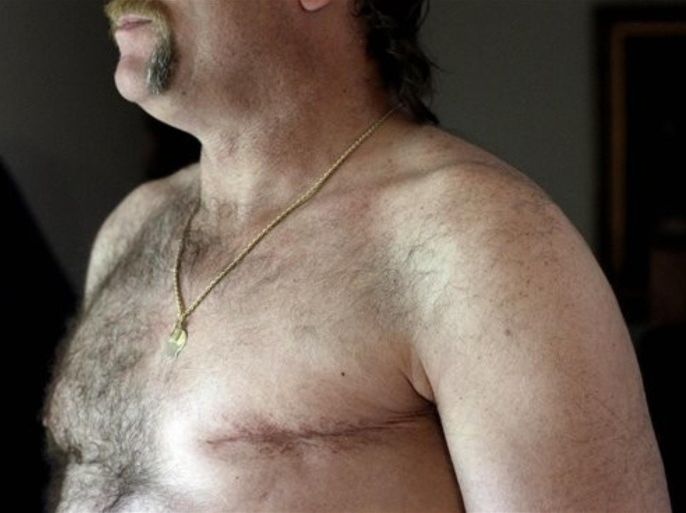 In this May 3, 2012 photo, a surgery scar is seen on breast cancer survivor Robert Kaitz's left breast in his home in Severna Park, Md. Kaitz thought a small growth under his left nipple was just a harmless cyst. By the time he had it checked out in 2006, almost two years later, the lump had started to hurt. The diagnosis was a shock. "I had no idea in the world that men could even get breast cancer," Kaitz said. Now Kaitz does frequent self-exams and has mammograms every year. The American Cancer Society estimates 1 in 1,000 men will get breast cancer, versus 1 in 8 women.