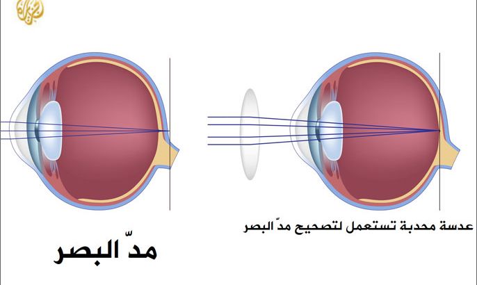 مد البصر، نظارة، نظارة لعلاج مد البصر
