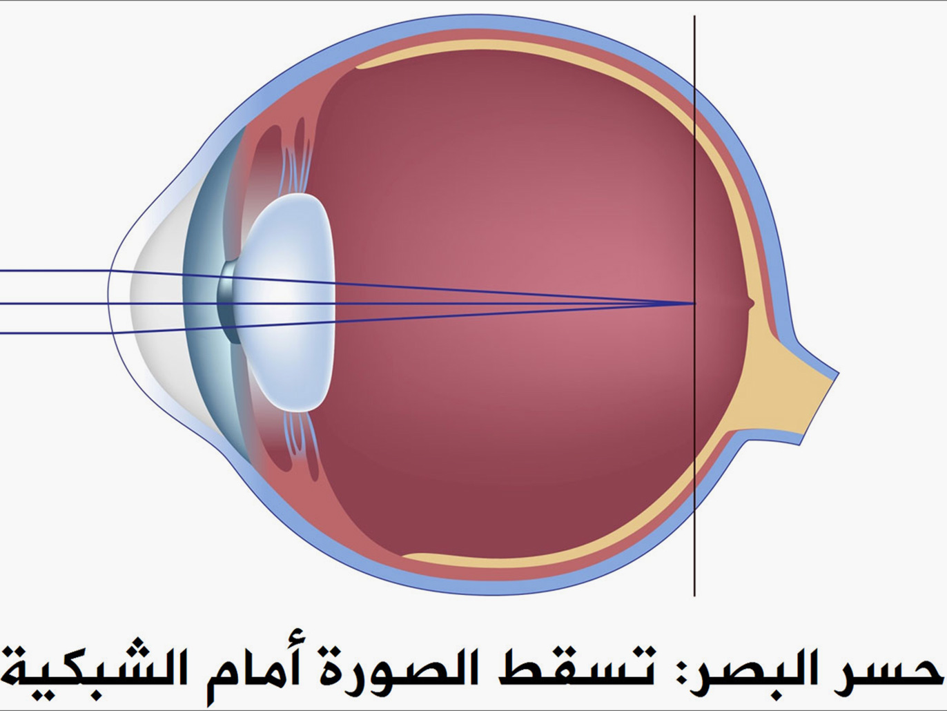 Фокусировка глаза человека. Эмметропия миопия гиперметропия. Близорукость и дальнозоркость сетчатка. 13. Дальнозоркость (гиперметропия).. Миопия хрусталик.