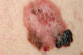 دراسة: كريمات الحماية لا تقي من سرطان الجلد الأسود