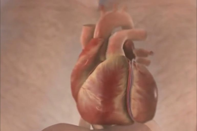 تقنية إسعـاف جديدة تنقذ حياة مرضى النوبات القلبية