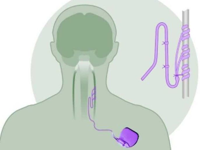 UNDATED - This Cyberonics, Inc. handout shows the placement in the body of the Vagus Nerve Stimulation (VNS) Therapy System, designed as a surgical implant that helps clinically depressed patients. The FDA announced on June 15, 2004 that it has voted to approve the device with conditions on labeling and education of the therapy. VNS therapy stimulates different areas of the brain by sending electrical pulses through the vagus nerve. The therapy is also used to help epileptics who are resistant to pharmaceutical treatment.
