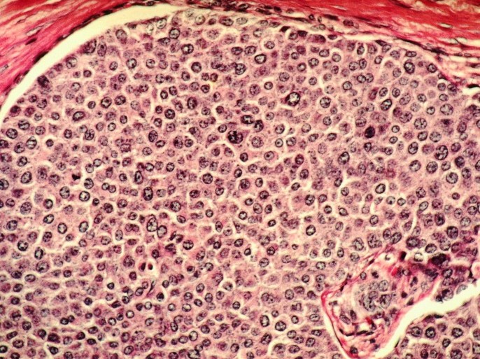 light microscope histology of breast cancer cells
