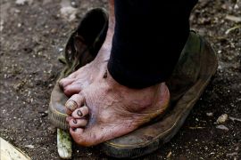 epa03741061 (04/15) A view of the feet of 76-year-old Zhao Jin Feng at her home in Luduo, China's Yunnan province, 02 April 2013. Mrs Zhao was quarantined by her husband while she was pregnant with her youngest son. Close to 80 people affected by Hansen's disease were quarantine in Luduo village when it was first established, but now there are only seven. Five of them, sent to Luduo when they had the disease, and the other two are men who were born in Luduo after their mothers were quarantined while pregnant. In China, most patients were quarantined in mountain villages or islands with little access at all. The majority died in these villages without ever seeing their relatives again, even after they were cured. EPA